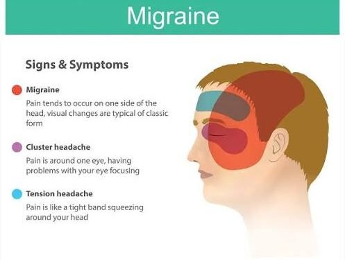 Migraine Symptoms